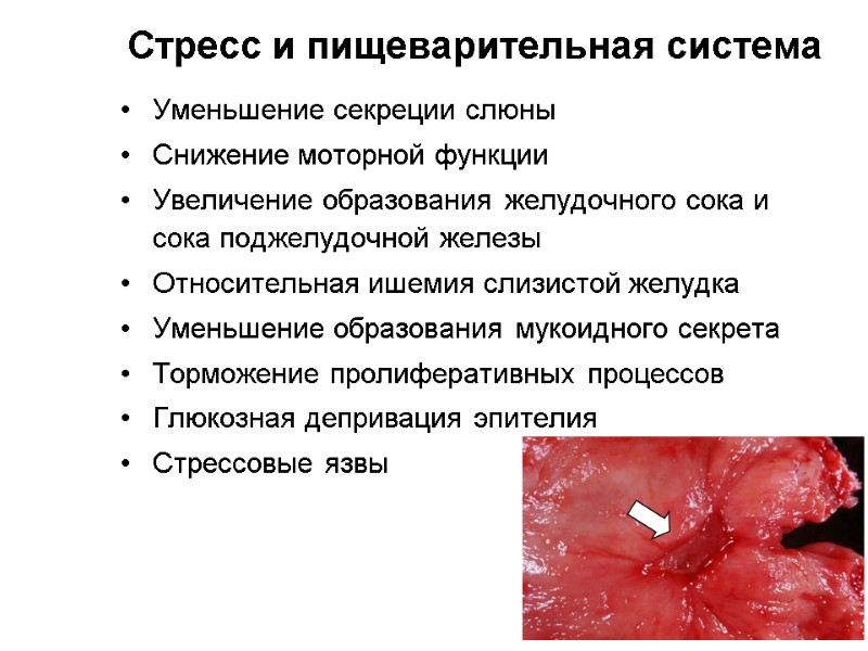 Стресс и пищеварительная система Уменьшение секреции слюны Снижение моторной функции Увеличение образования желудочного сока